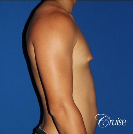 young athletic adult with puffy nipple - Before and After Image 3