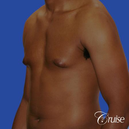 young body builder has puffy nipple and gets gynecomastia surgery - Before Image 3