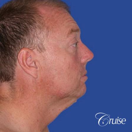best male chin implant with large square jaw - Before and After Image 2
