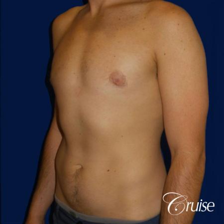Type 2 Gynecomastia Glandular Removal - After Image 2