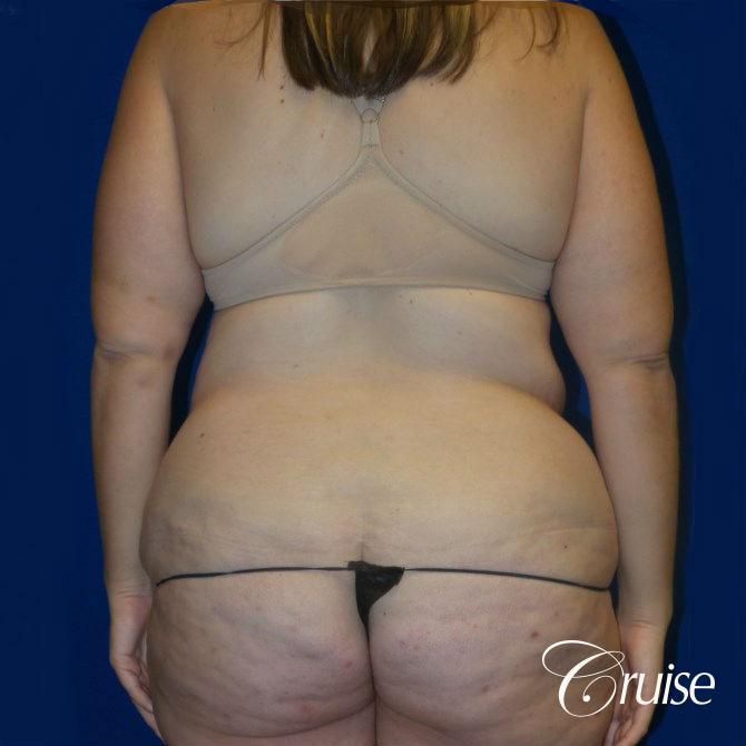 best circumferential tummy tuck photos - Before and After 3