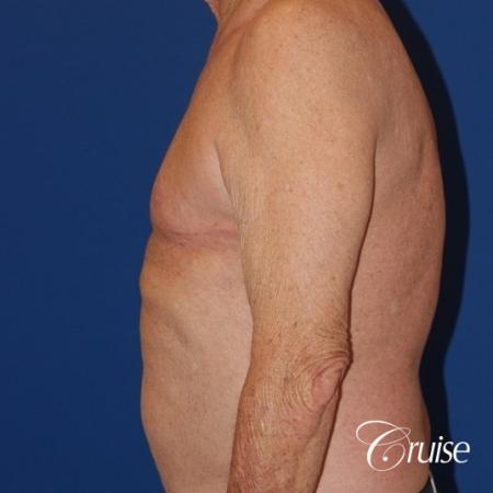 free nipple graft gynecomastia on old man - After Image 3