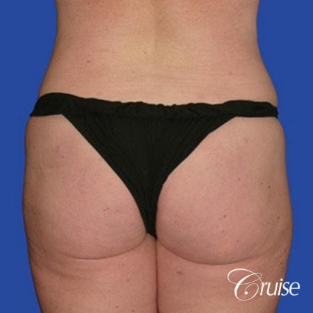 best pictures of liposuction abdomen with skin laxity - After Image 1