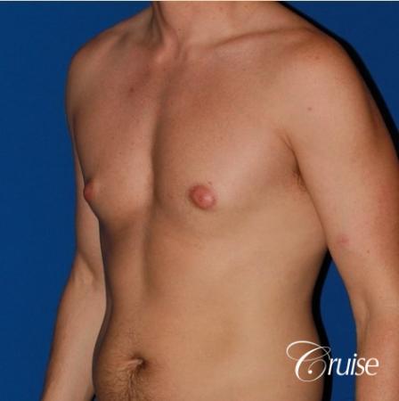 puffy nipple on 35 yr old male - Before and After Image 3
