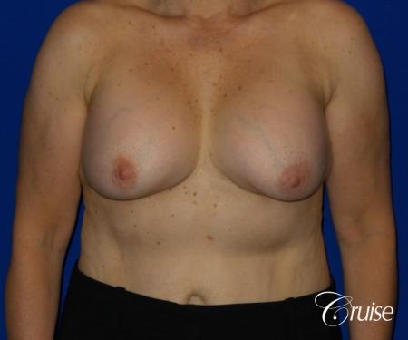 Before Image 1