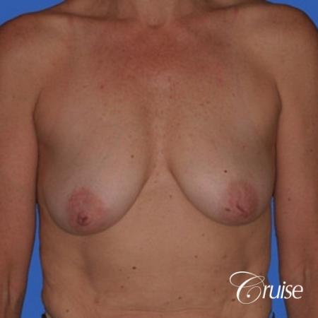 best breast lift donut pictures on mature woman - Before Image 1