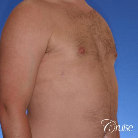 male adult with gynecomastia - After Image 3