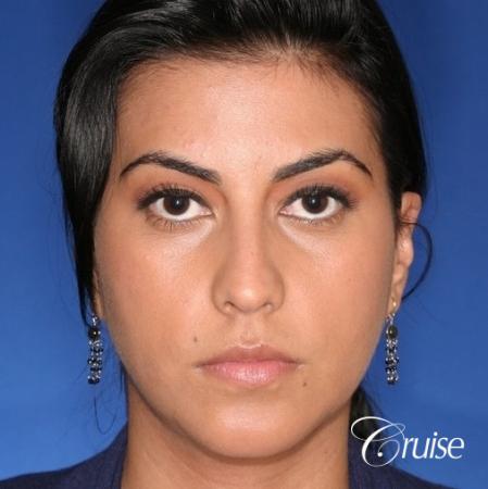 best XL chin implant on female patient - After Image 1
