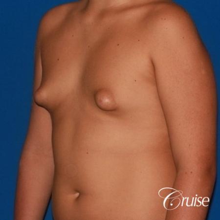 severe puffy nipple on teenager - Before and After Image 3