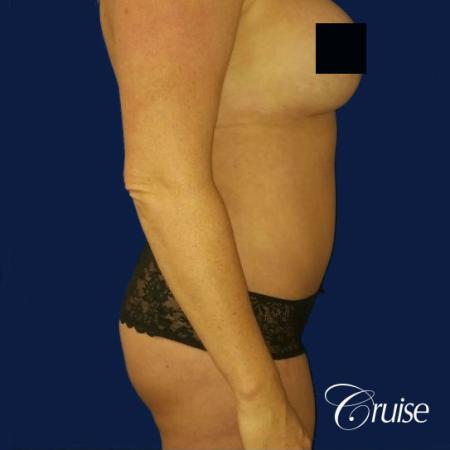 Best tummy tucks dr cruise - After Image 4