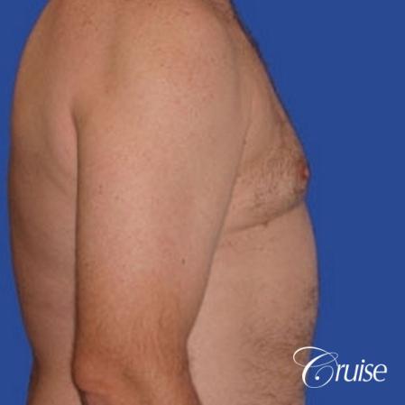 chest liposuction on adult - After Image 3