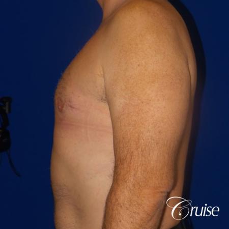 gynecomastia surgery results - After Image 3