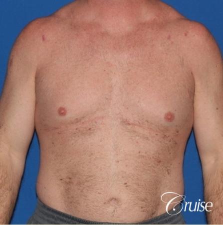 extended pa incision on gynecomastia patient - Before Image 1