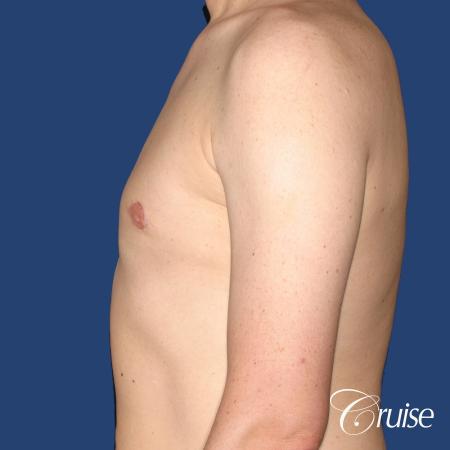 moderate gynecomastia on adult with donut lift scar - After Image 2