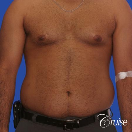 young adult with gyno gets gynecomastia surgery - Before Image 1