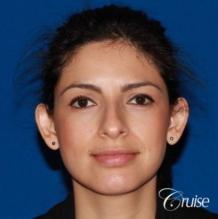 best otoplasty with natural appearance on female - Before Image 1