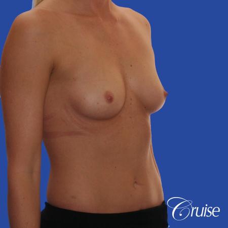 Breast Augmentation - Before Image 3