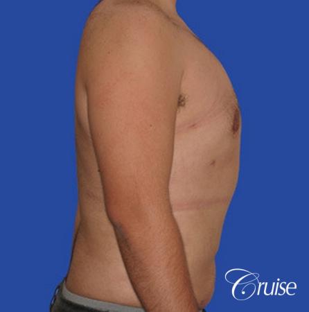 male liposuction abdomen flanks with Gynecomastia - After Image 5