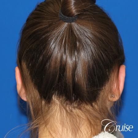 best before and after pictures of otoplasty - After Image 2