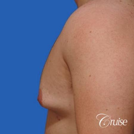 mild gynecomastia with puffy nipple on adult - Before and After Image 2