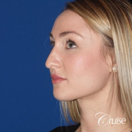 best rhinoplasty with natural results - Before Image 2