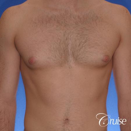 body builder with puffy nipples gets gyne surgery - Before Image 1