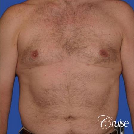 chest liposuction on adult - After Image 1