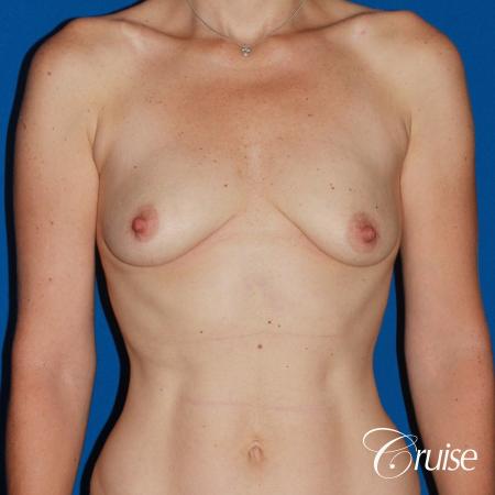young woman with silicone breast lift anchor - Before Image 1