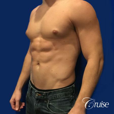 body builder puffy nipple gynecomastia - Before 3