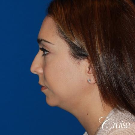 best medium chin implant on young patient - Before Image 2