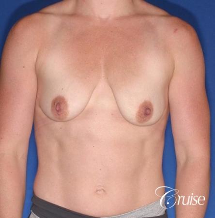 best breast lift anchor on athletic body type - Before Image 1