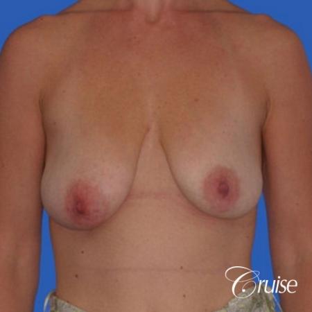 best breast lift anchor with silicone implants - Before Image 1