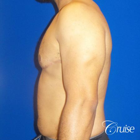 Best gynecomastia specialist in united states - After Image 3