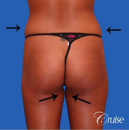best liposuction abdomen and love handles - Before and After Image 3
