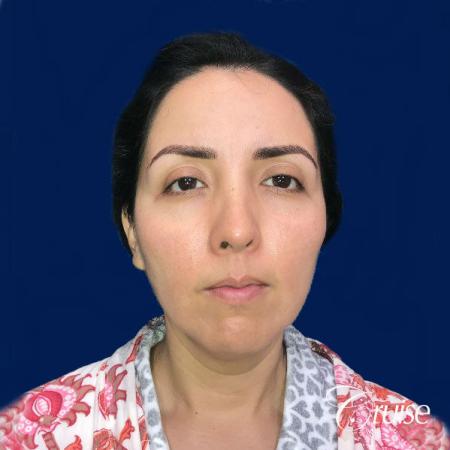Liposuction of Neck/Jawline - Before Image 1