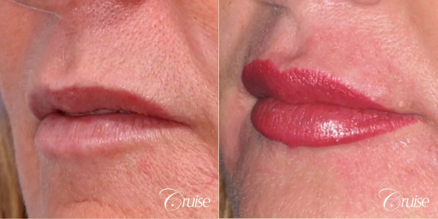 best lip augmentation with juvaderm - Before and After 2