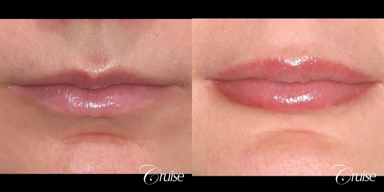 best fillers plastic surgeon does lip augmentation - Before and After 1