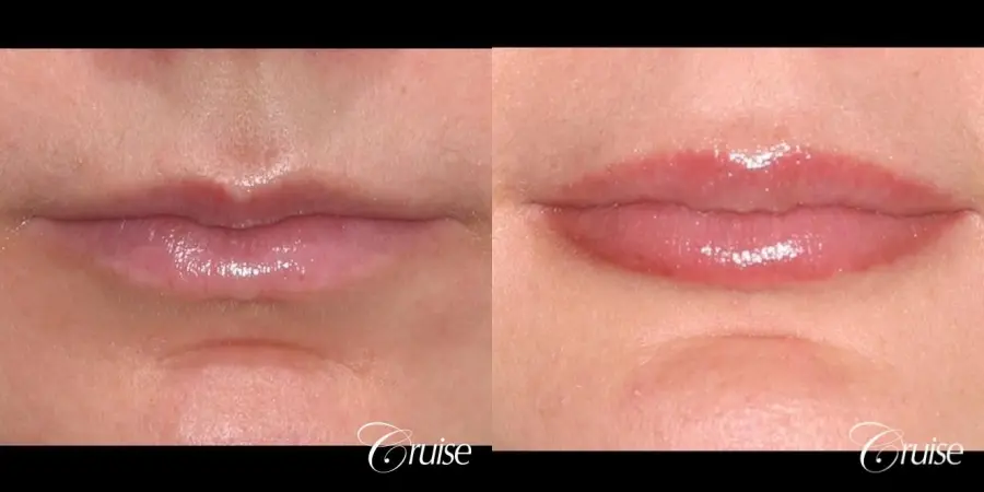 best fillers plastic surgeon does lip augmentation - Before and After