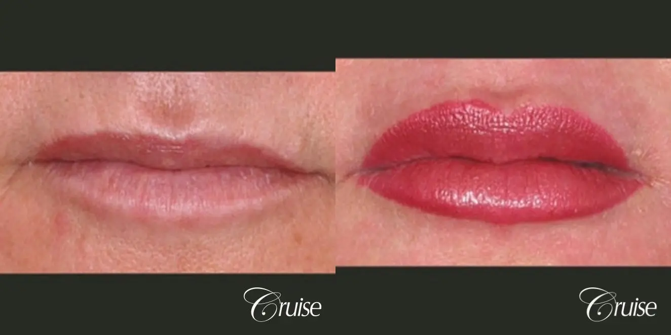 best lip augmentation with juvaderm - Before and After