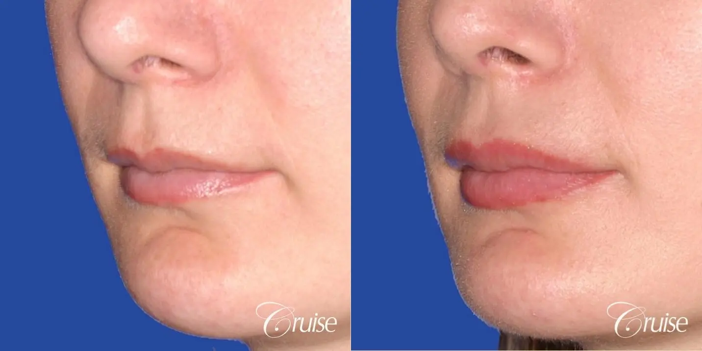 best fillers plastic surgeon does lip augmentation - Before and After 2