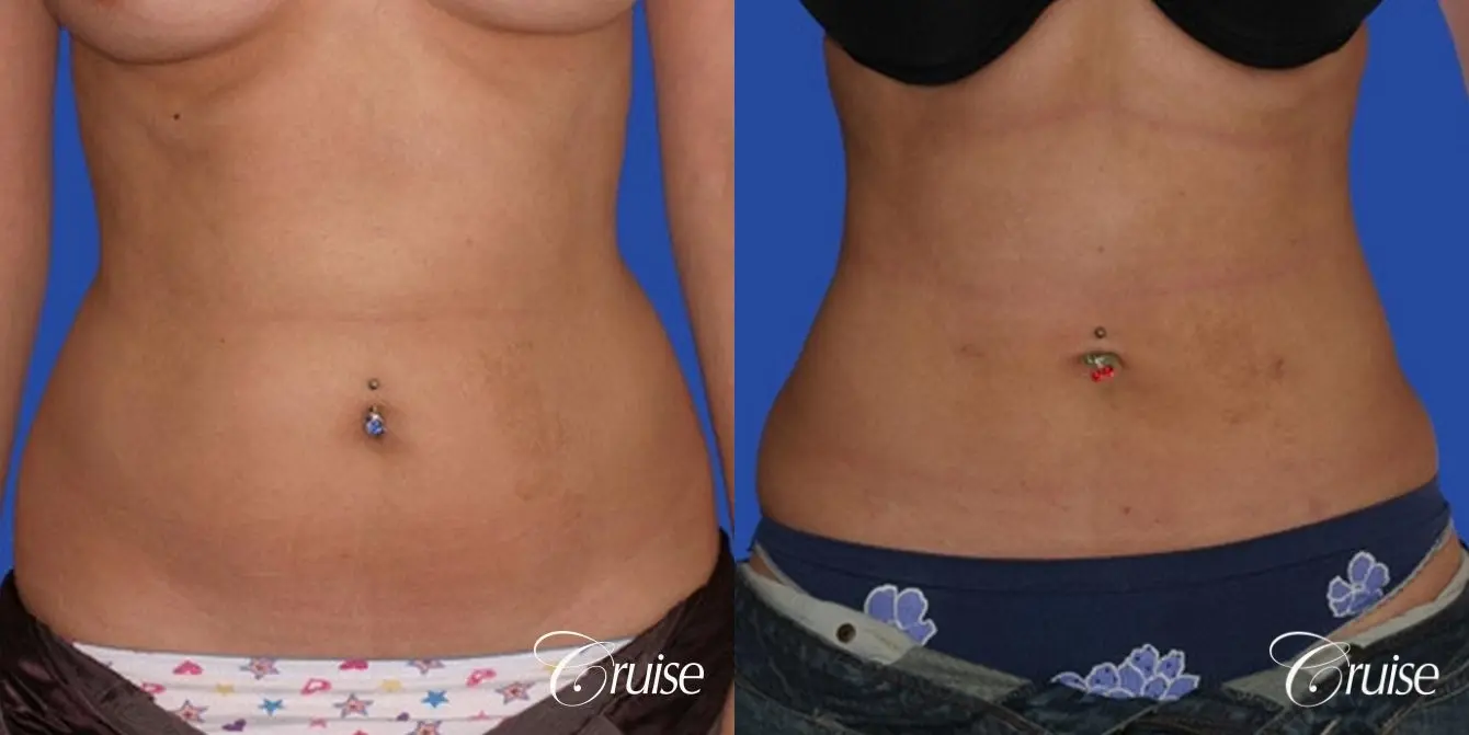 top plastic surgeon for liposuction in Newport Beach - Before and After 1