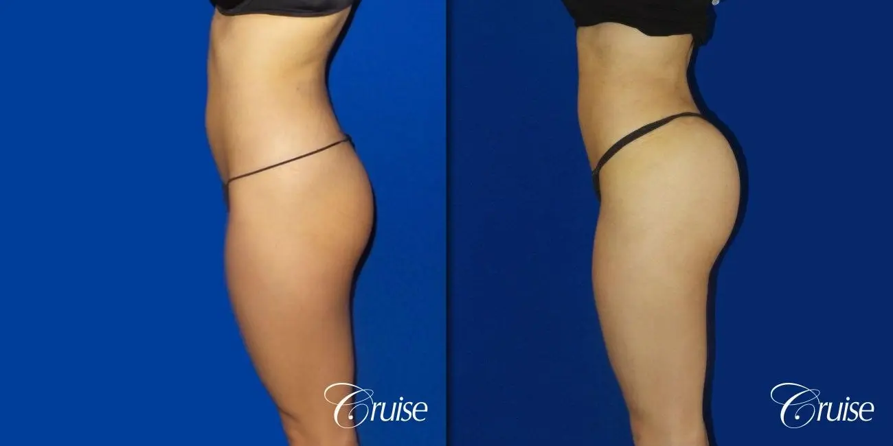 Brazilian Butt Lift - Before and After 2