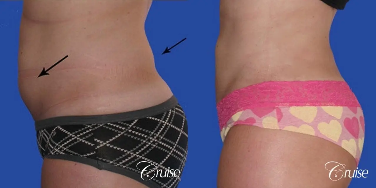 Liposuction: Patient 27 - Before and After 2