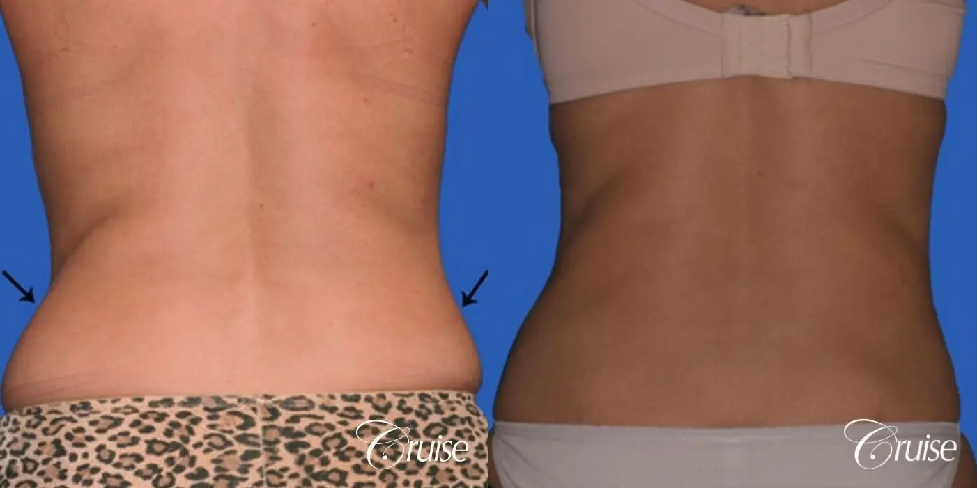 best lipo photos of love handles and stomach - Before and After 2