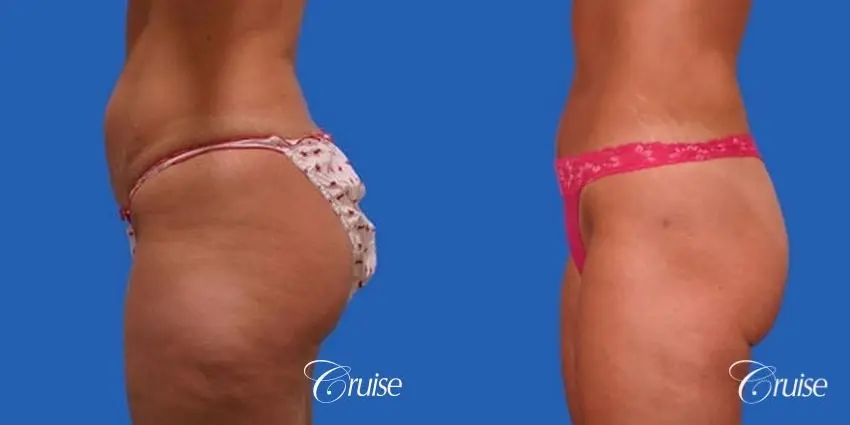 before and after pictures of liposuction abdomen and flanks - Before and After 2