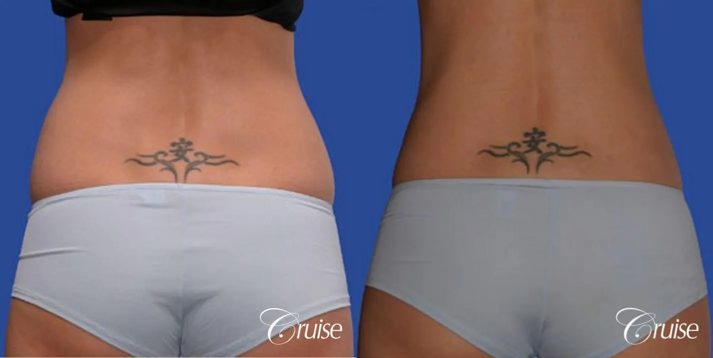 best hove handle treatment with liposuction flanks - Before and After 2