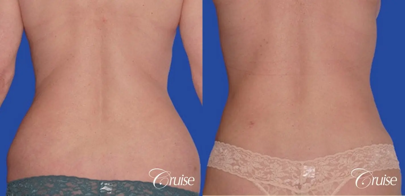 mini tummy tuck and lipo flanks in Newport Beach - Before and After 1