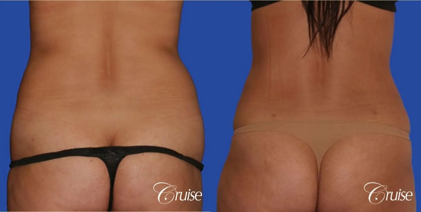 best flanks lipo before and after pictures - Before and After 1