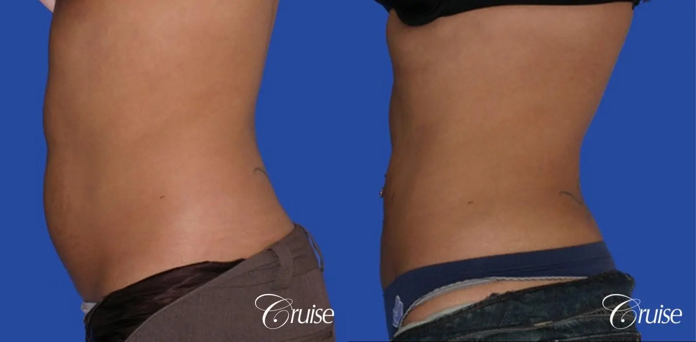 top plastic surgeon for liposuction in Newport Beach - Before and After 2