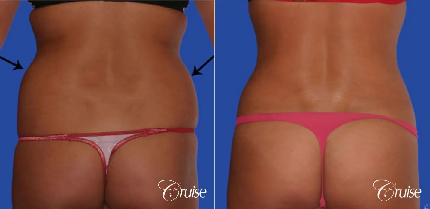 tummy tuck with lipo contouring pictures - Before and After 2